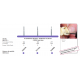 Zirconia Instrument - FG DIAMONDS 532678L DFS Zirconia Tools Rs.602.67