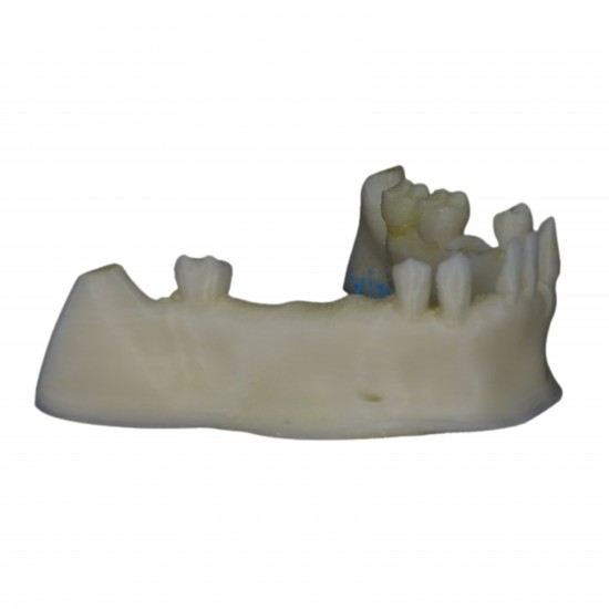 Partially Edentulous Mandible V-Invent Hands On Models Rs.2,856.19