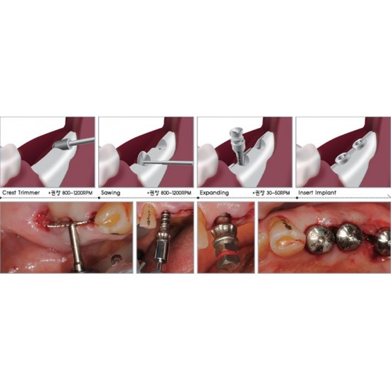Bone Expander Set of 12 WALDENT Dental Instruments Rs.17,857.14