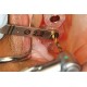 Lindemann Drill Titanium Coated WALDENT Dental Instruments Rs.2,142.85