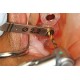 Lindemann Drill Titanium Coated Lindemann Drill Titanium Coated WALDENT Dental Instruments Rs.2,142.85